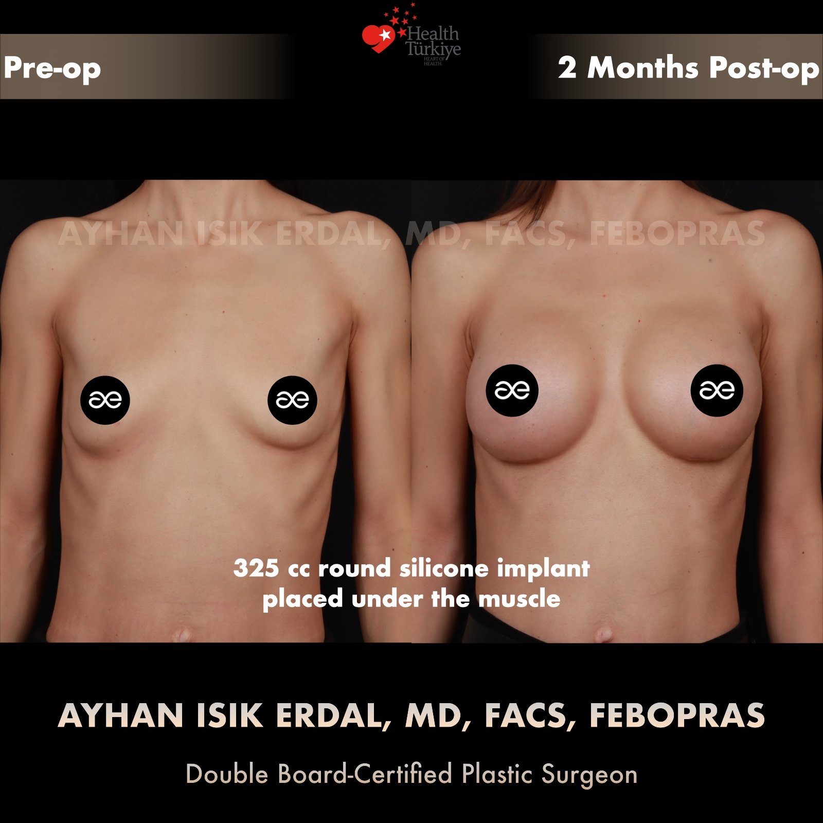 Breast augmentation — 325 cc · Under Muscle, frontal view, 2 Months Post-op