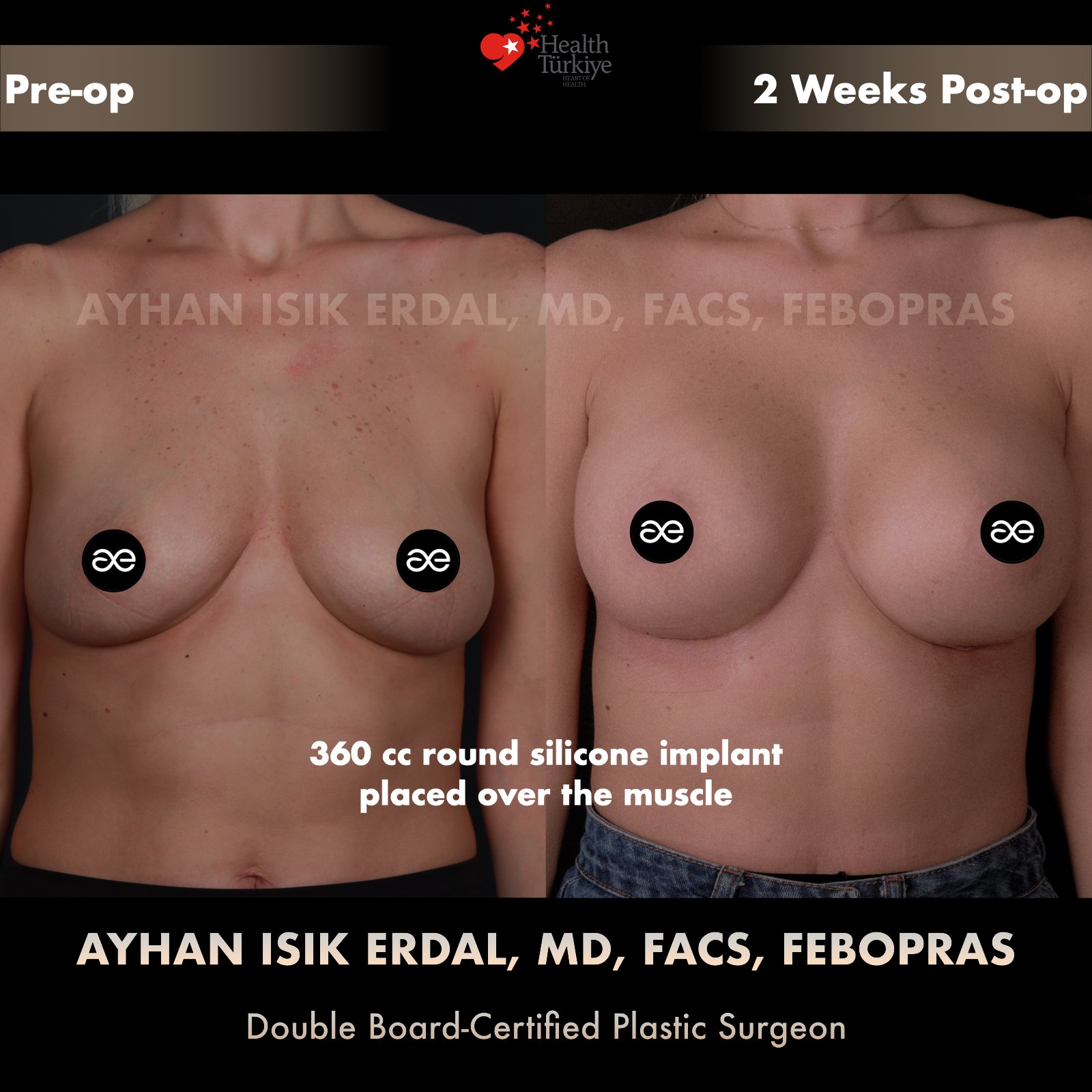 Breast augmentation — 360 cc · Over Muscle, frontal view, 2 Weeks Post-op