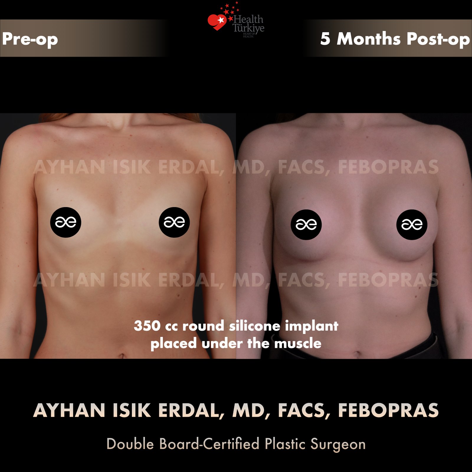 Breast augmentation — 350 cc · Under Muscle, frontal view, 5 Months Post-op