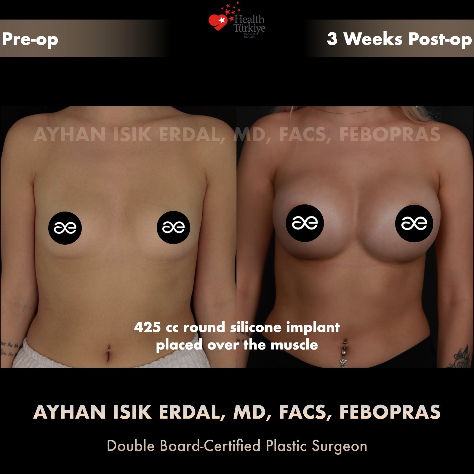 Breast augmentation — 425 cc · Over Muscle, frontal view, 3 Weeks Post-op