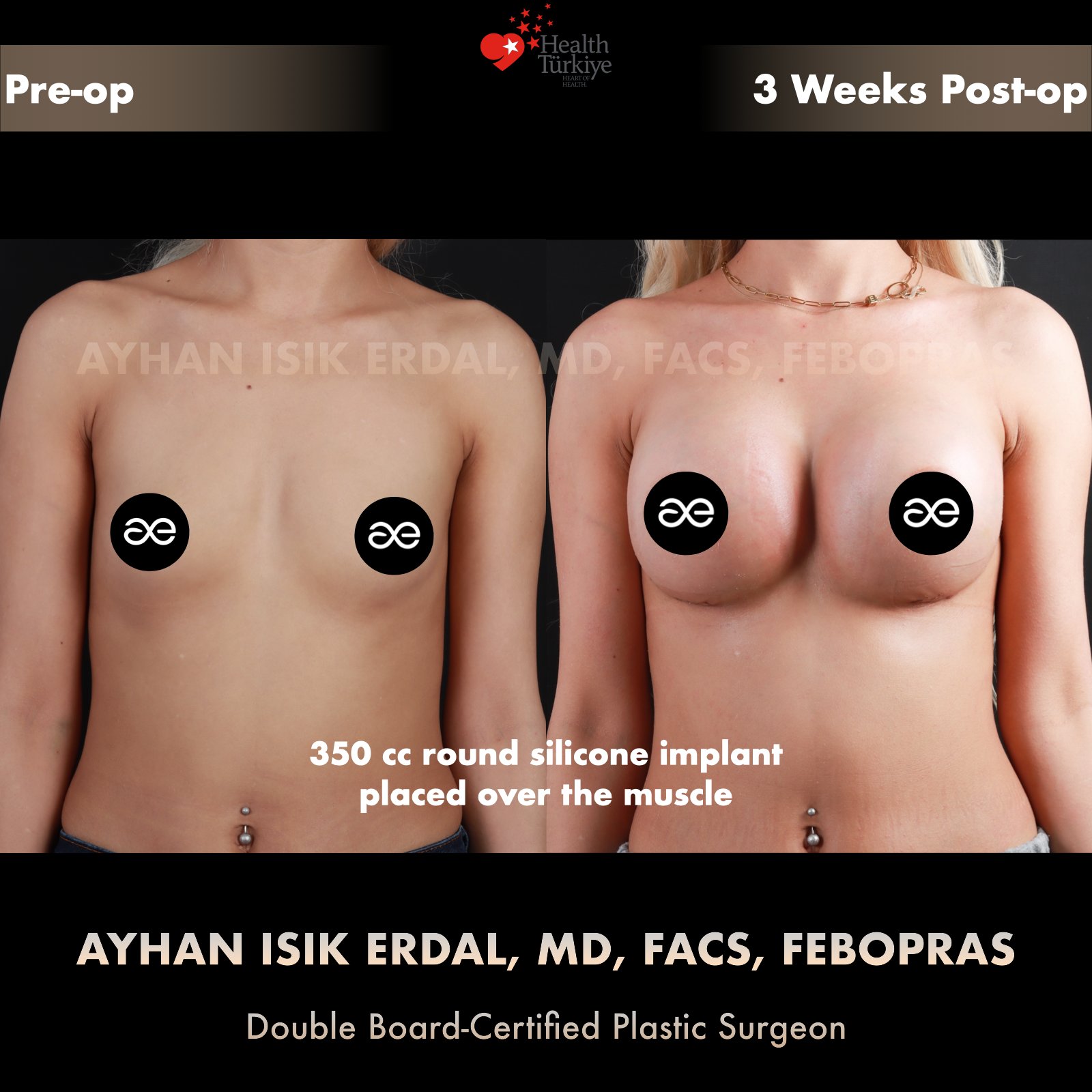 Breast augmentation — 350 cc · Over Muscle, frontal view, 3 Weeks Post-op
