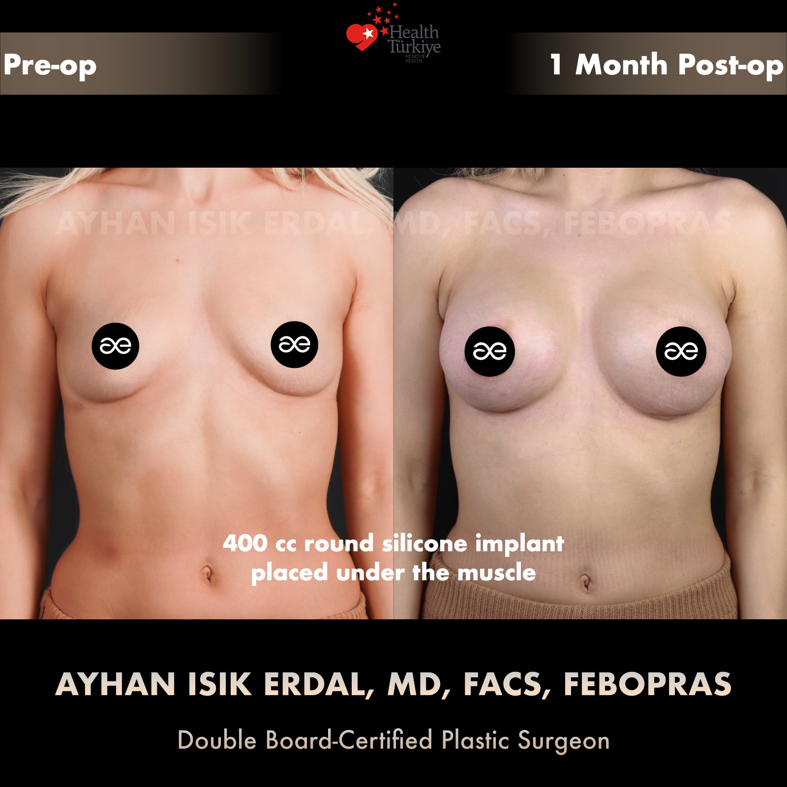 Breast augmentation — 400 cc · Under Muscle, frontal view, 1 Month Post-op