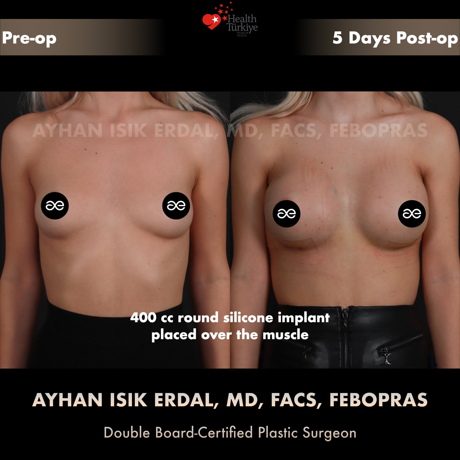 Breast augmentation — 400 cc · Over Muscle, frontal view, 5 Days Post-op
