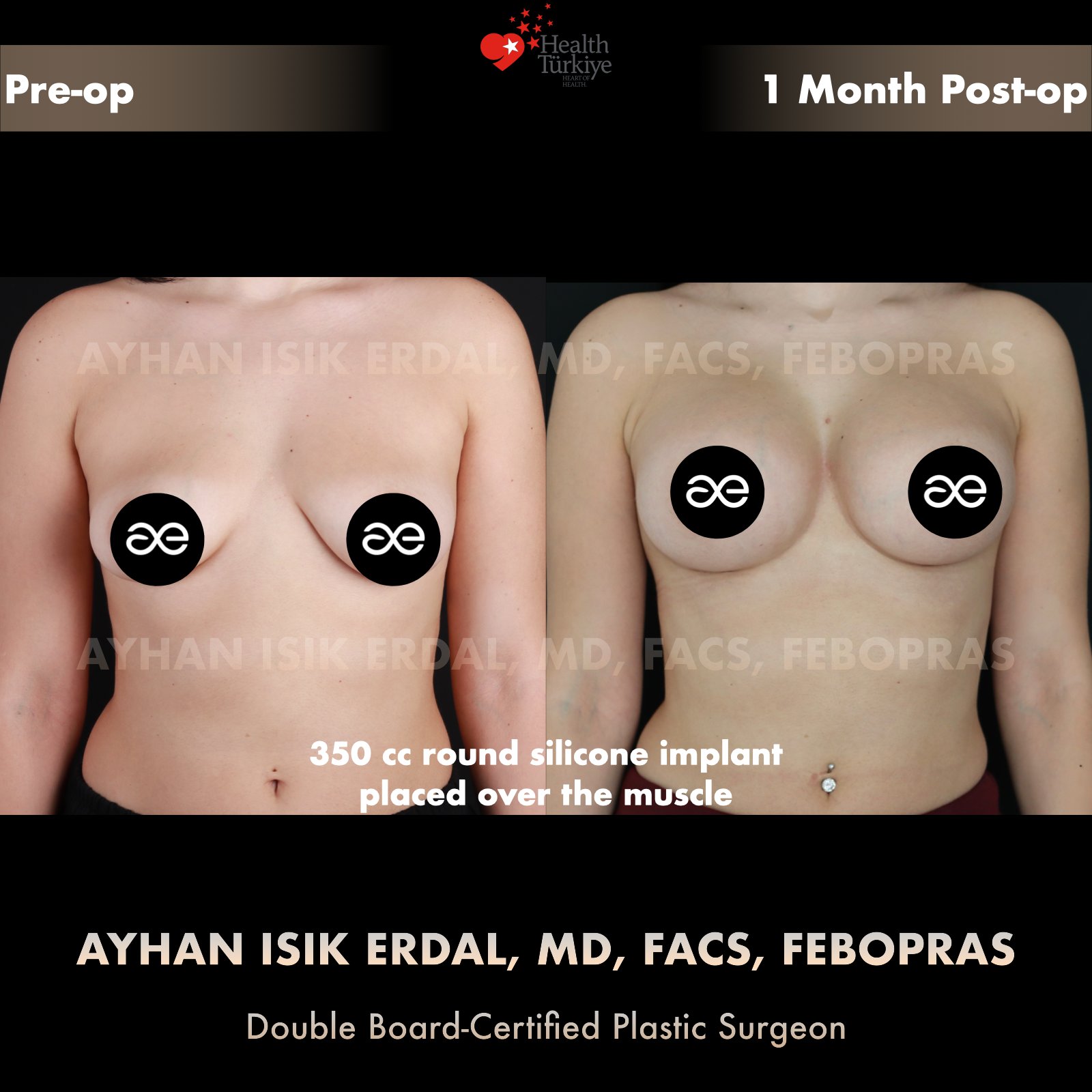 Breast augmentation — 350 cc · Over Muscle, frontal view, 1 Month Post-op