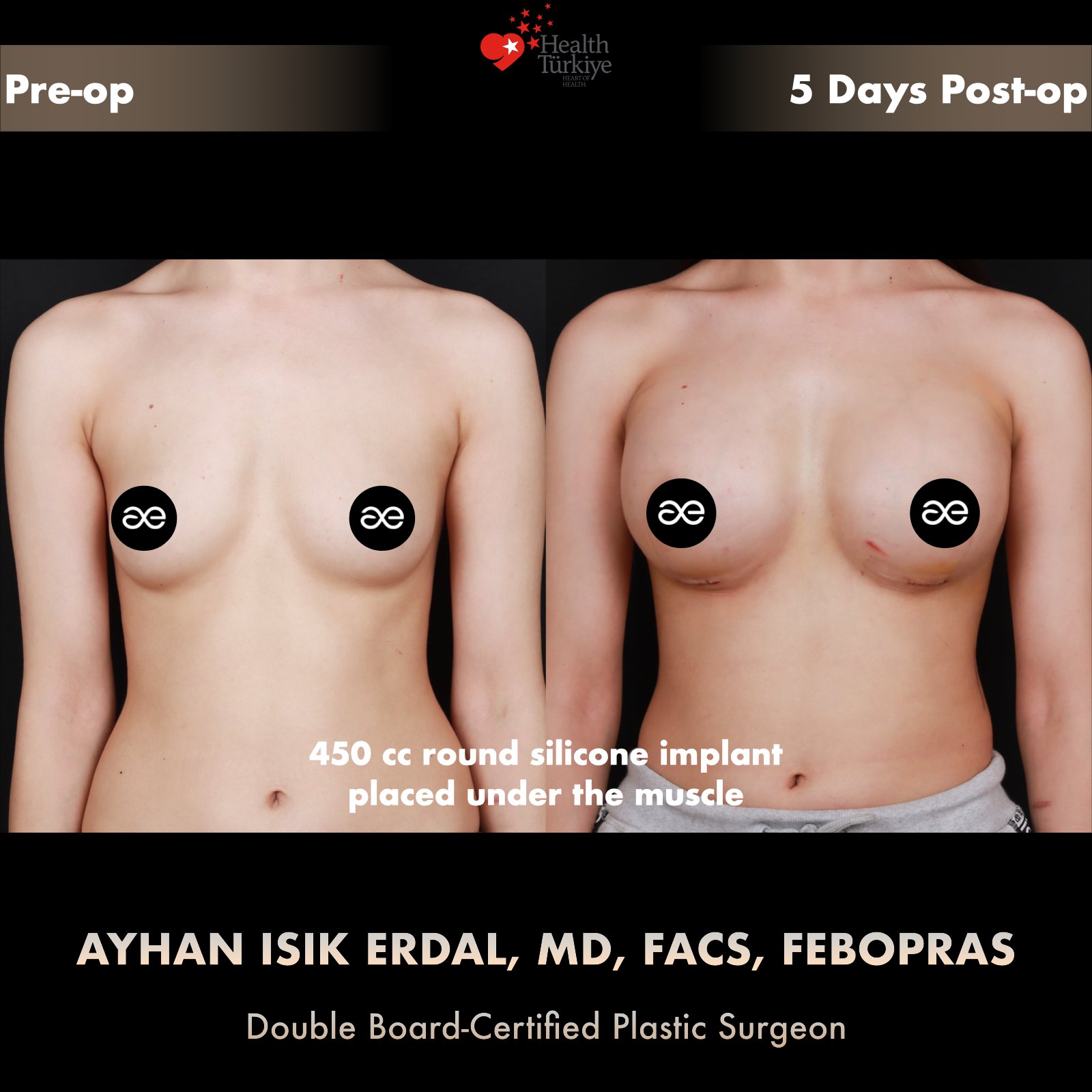 Breast augmentation — 450 cc · Under Muscle, frontal view, 5 Days Post-op