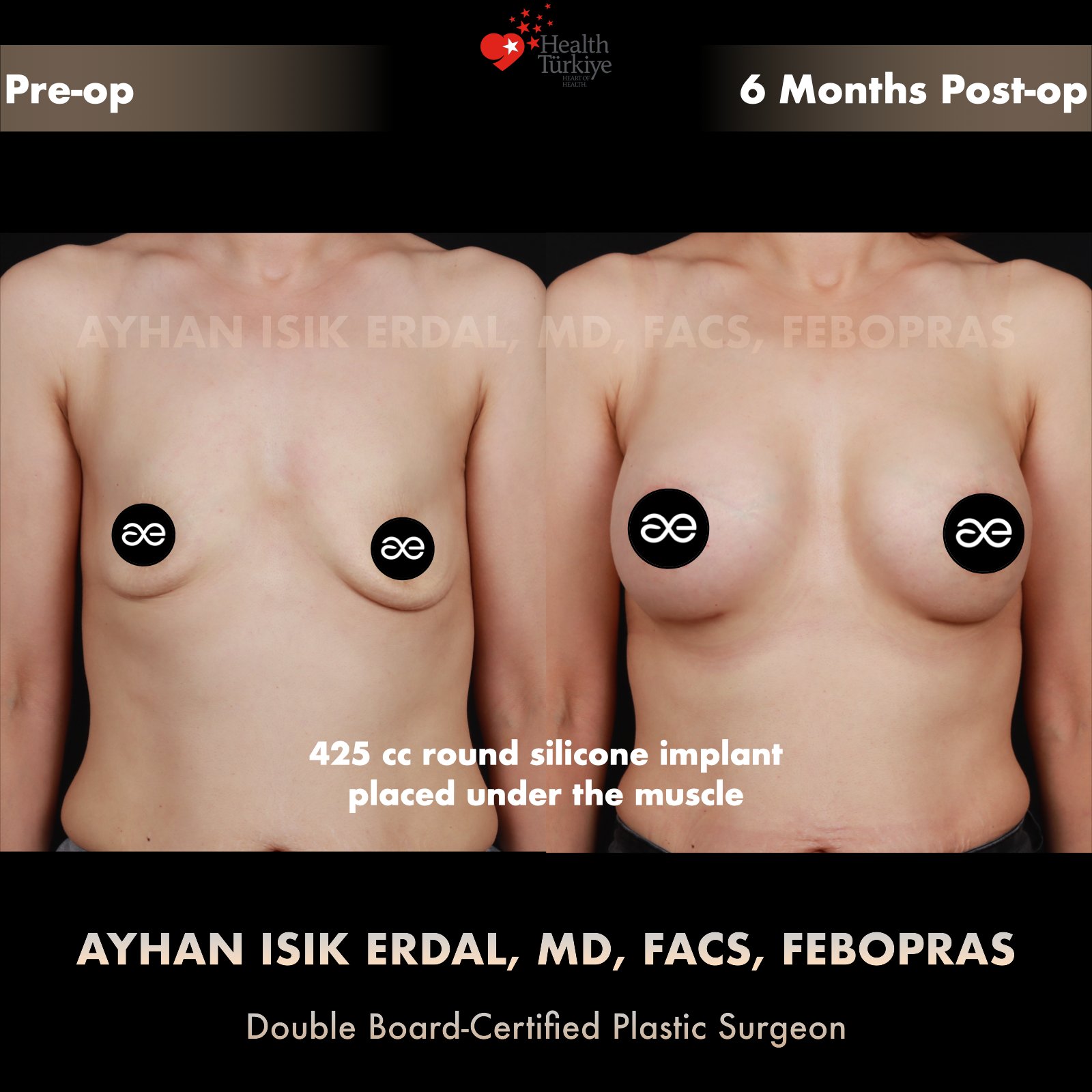 Breast augmentation — 425 cc · Under Muscle, frontal view, 6 Months Post-op